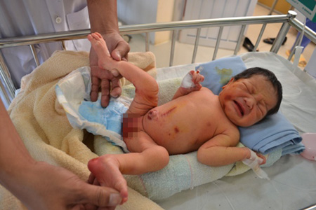 Bé gái đang được điều trị tại Bệnh viện Đa khoa tỉnh Đắk Lắk với nhiều vết thương trên cơ thể