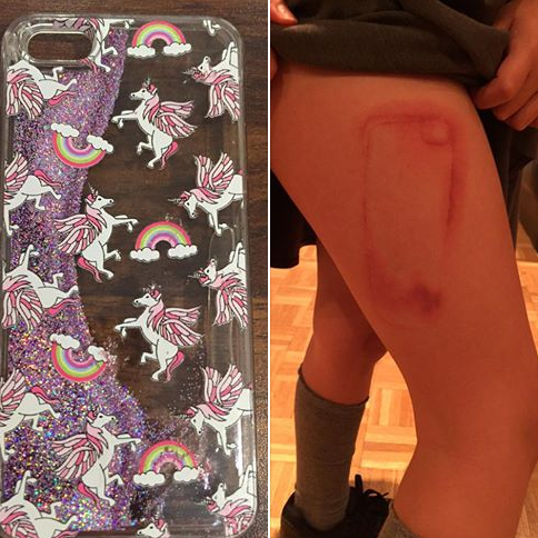 
Trường hợp bé gái 9 tuổi ở Anh sử dụng loại case iPhone trong suốt, có dung dịch và kim tuyến bên trong để trang trí, chiếc case này đã bục ra khi cô bé đang ngủ. Dung dịch đó trào khỏi điện thoại và dây vào đùi, tạo thành một vết bỏng in hình điện thoại.
