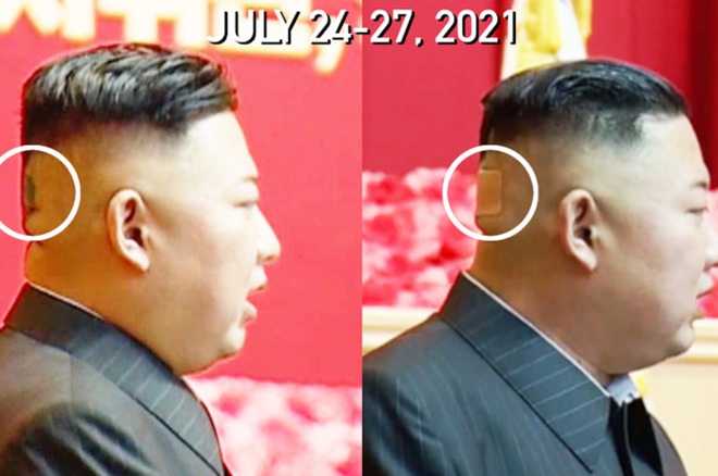 Băng dán y tế trên đầu ông Kim Jong-un gây chú ý - 1
